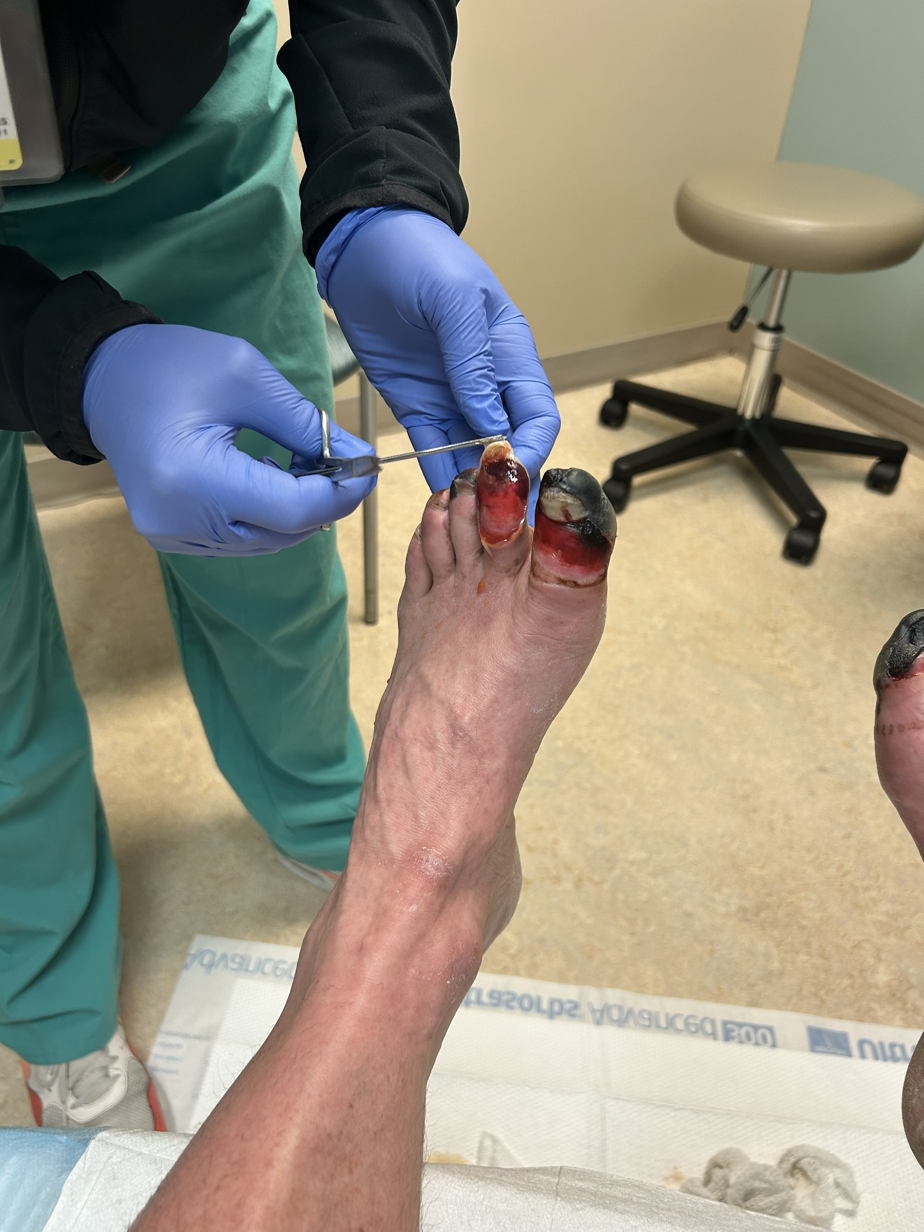 Debridgement of dead tissue Debridement of dead tissue a few weeks after the injury. Photo: G. Huey