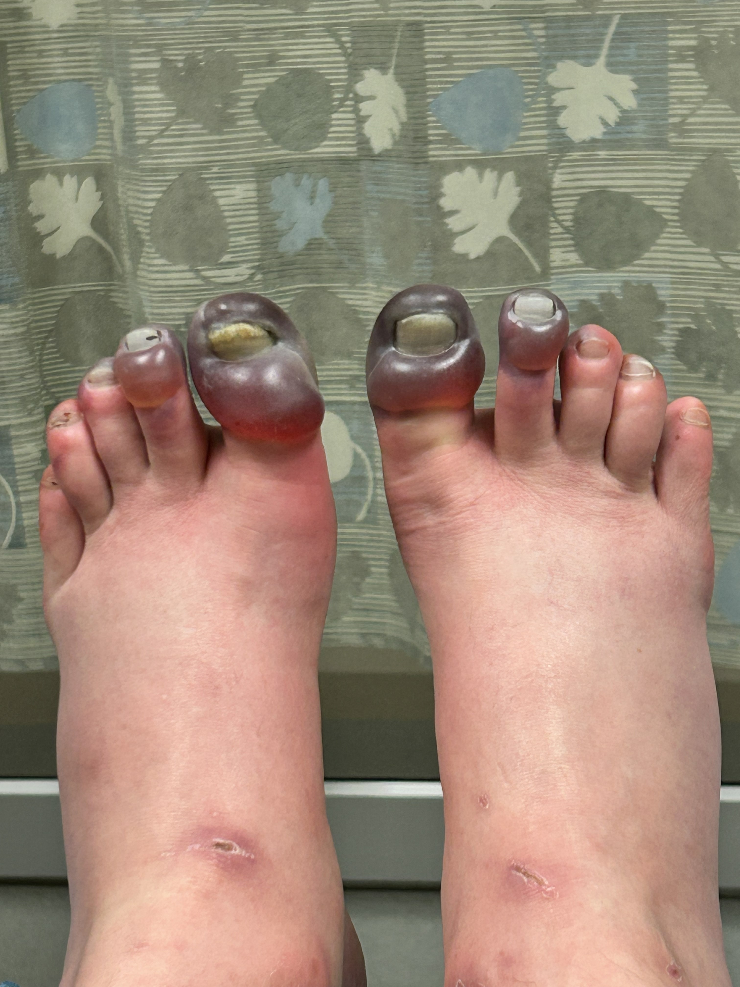 Greg feet post evactuation Greg’s feet in the hospital post-evacuation, about 5 days after injury. Photo: G. Huey
