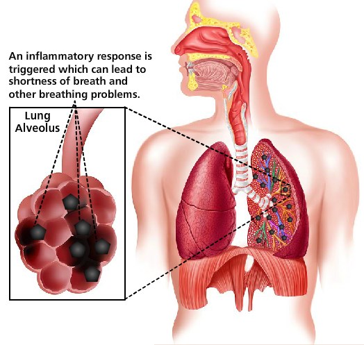 lt= A diagram of a human respiratory system and closeup of a lung alveolus, the small sacs in which air exchange takes place. Dark particles are trapped in the alveolus. Caption: an inflammatory response is triggered which can lead to shortness of breath.